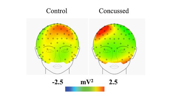 Illustration de l'activité cérébrale frontale chez deux sujets, l’un avec et l’autre sans commotion.